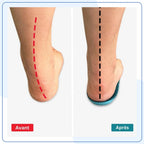 Semelles Orthopédiques Spéciales Hallux Valgus — vue 3