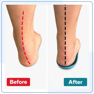 Semelles Orthopédiques Spéciales Hallux Valgus — vue 3