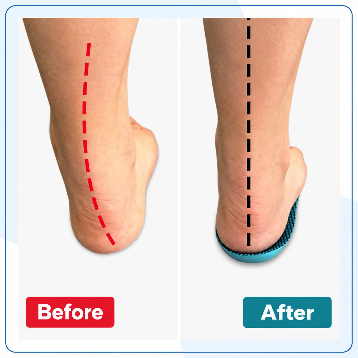 Semelles Orthopédiques Spéciales Hallux Valgus — vue 3